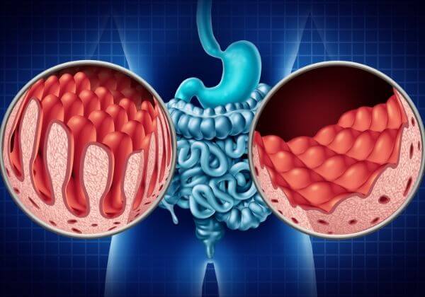 What Is Celiac Disease?