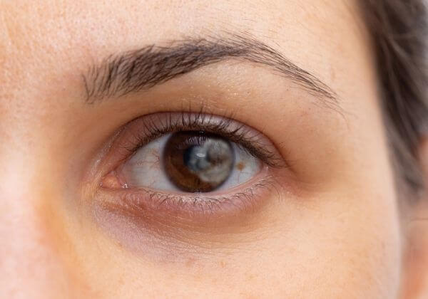 Cloudy Lens: Symptoms, Associated Diseases, and Treatment